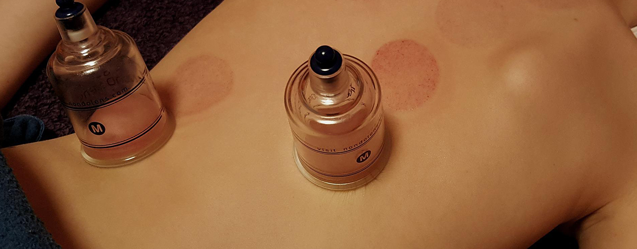 La Cupping Therapy fonctionne-t-elle vraiment sur les blessures en course à pied ?