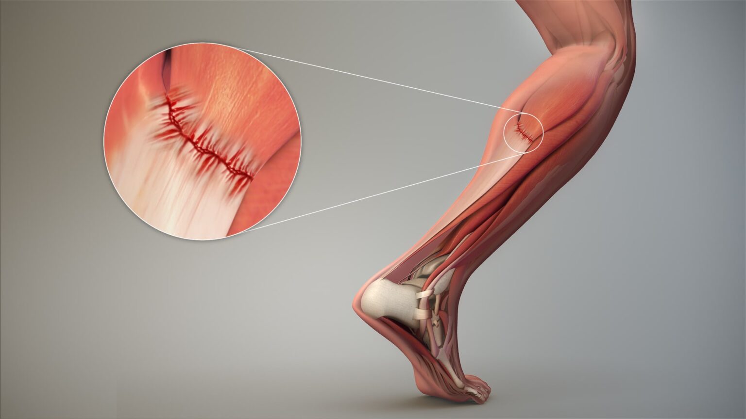 Crampes musculaires en course à pied Les causes + Conseils pour les éviter et les soigner