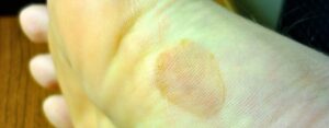 Ampoules en course à pied : Comment les éviter / les traiter ?