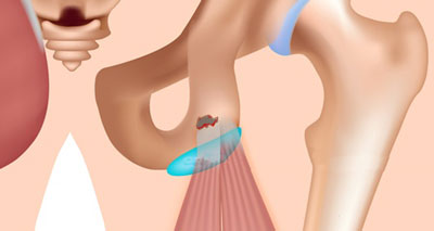 Avulsion du tendon des ischio-jambiers