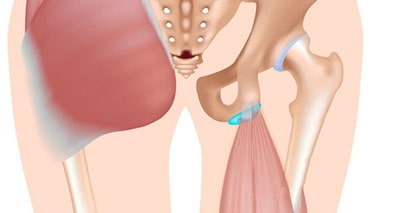 Poussée ischioglutéale/tendinopathie