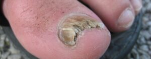 Pourquoi les ongles de pied des coureurs tombent-ils ? 4 conseils utiles pour les prévenir