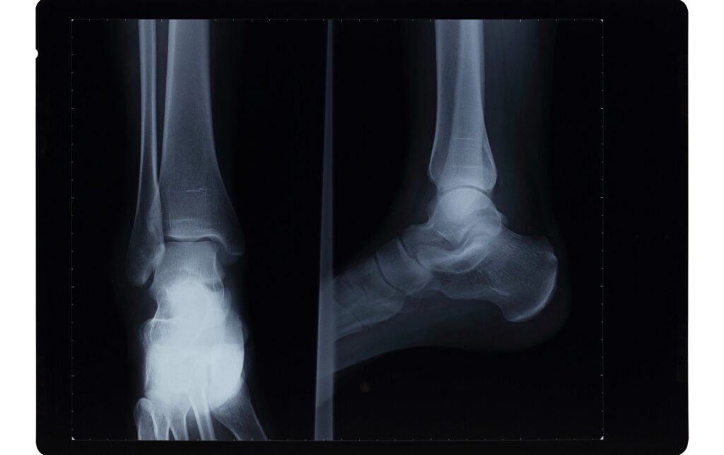 entorse cheville radio