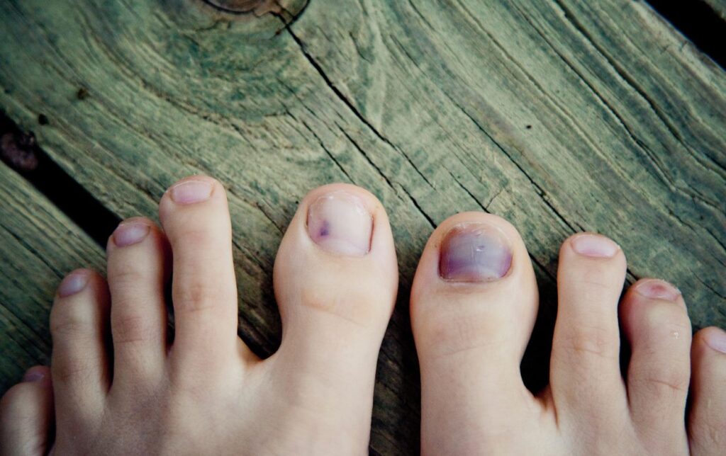 Pourquoi les ongles de pied des coureurs tombent-ils ? 4 conseils ...