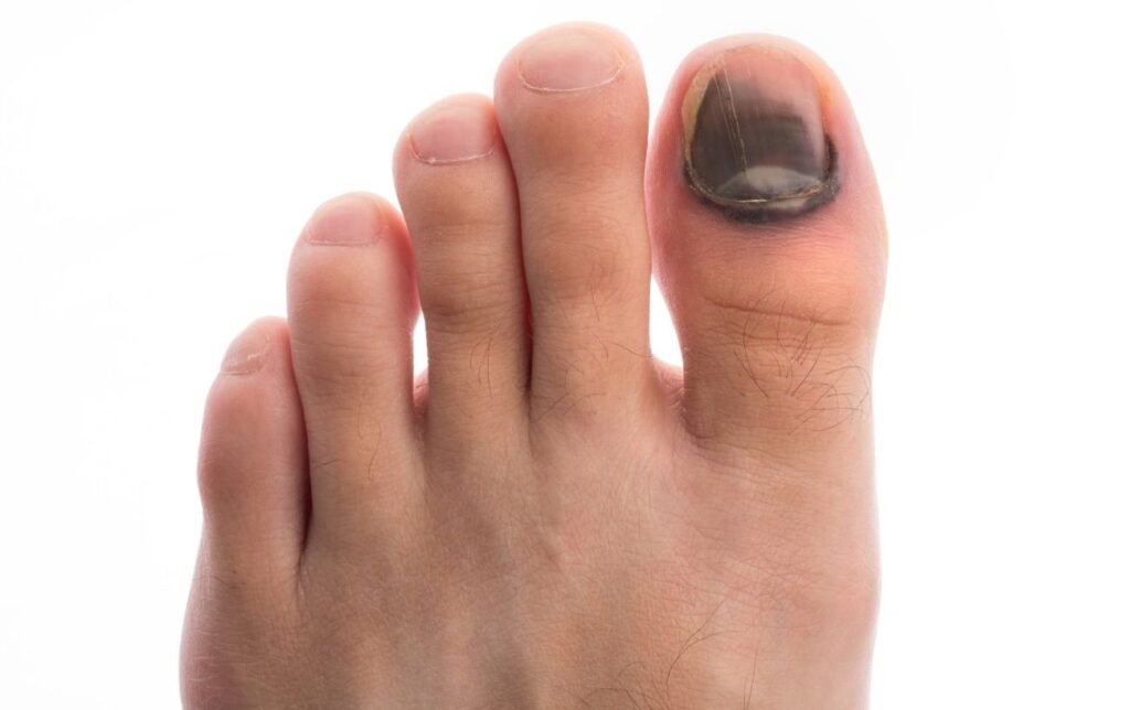 pied avec un ongle noir