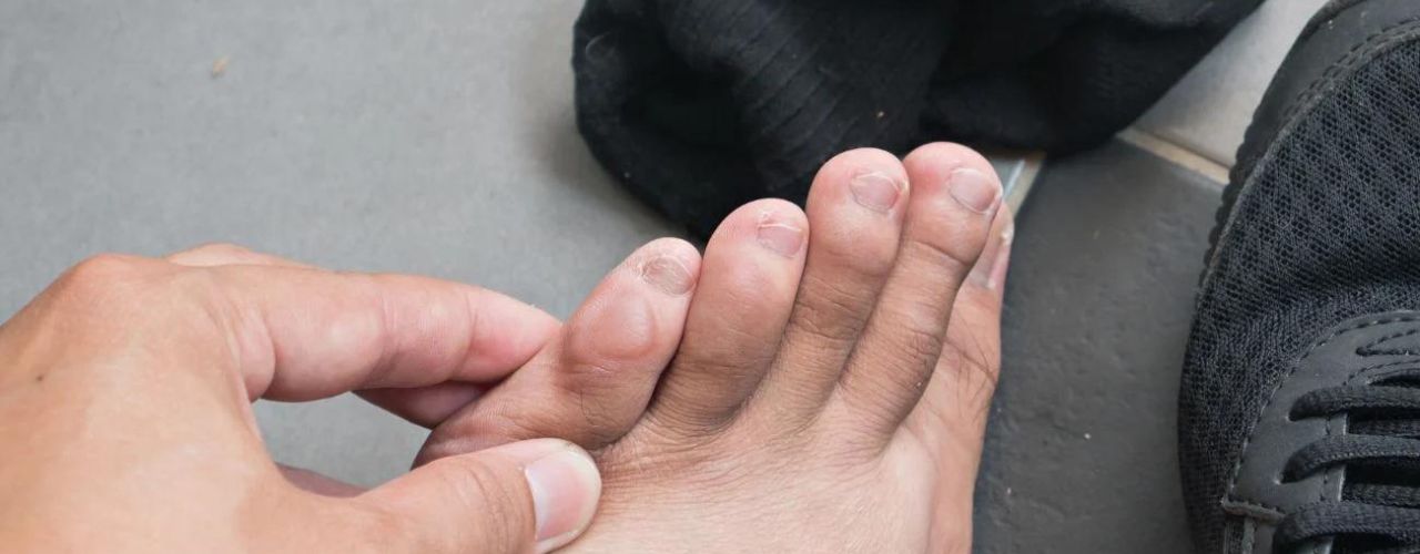 Irritations chez les coureurs : Comment prévenir et traiter les frottements ?